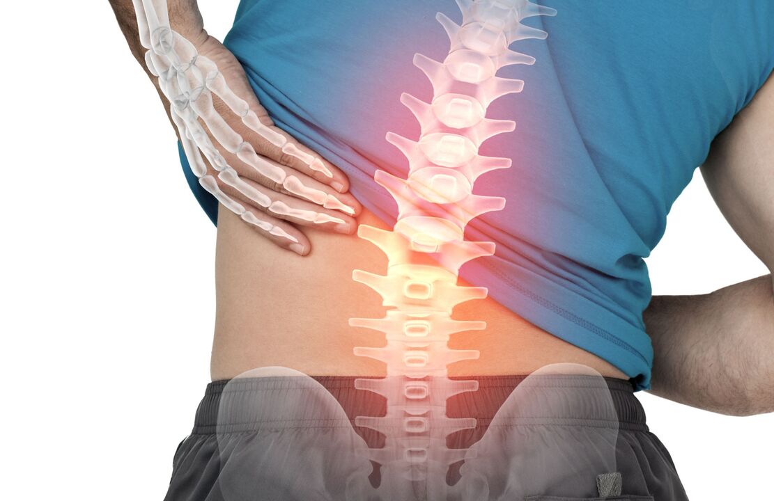 Die Gefahr der lumbalen Ostecondrose