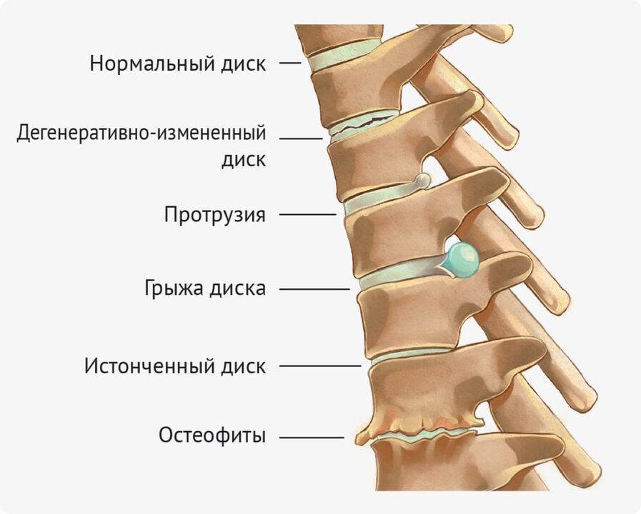 Scheibendeformitäten für die Lumbalosteochondrose