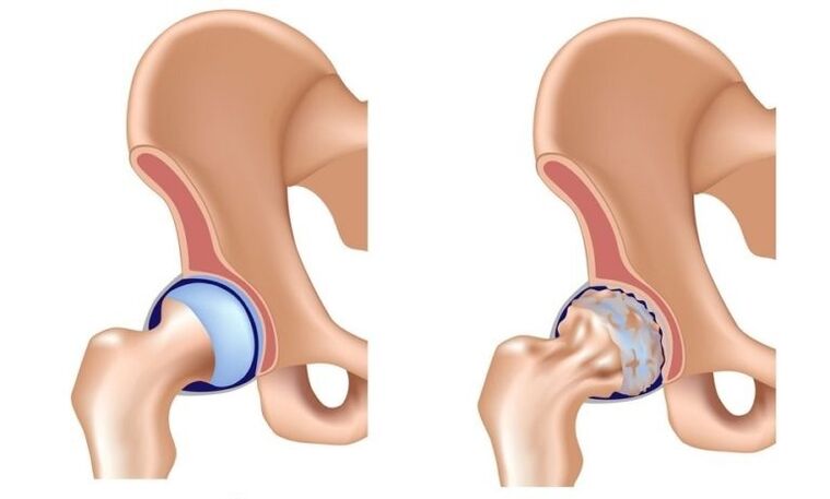 Gesunde Artikulation und Arthrose -Artikulation