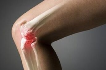 Die Arthrose des Kniegelenks ist eine Knorpelgewebeverletzung