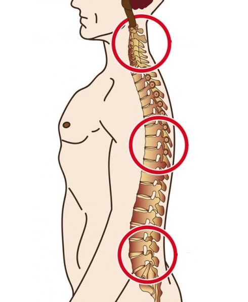 Säulenabteilungen, in denen Osteochondrose auftritt