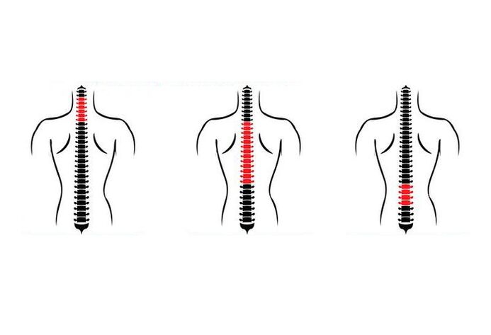 Wie äußert sich Osteochondrose