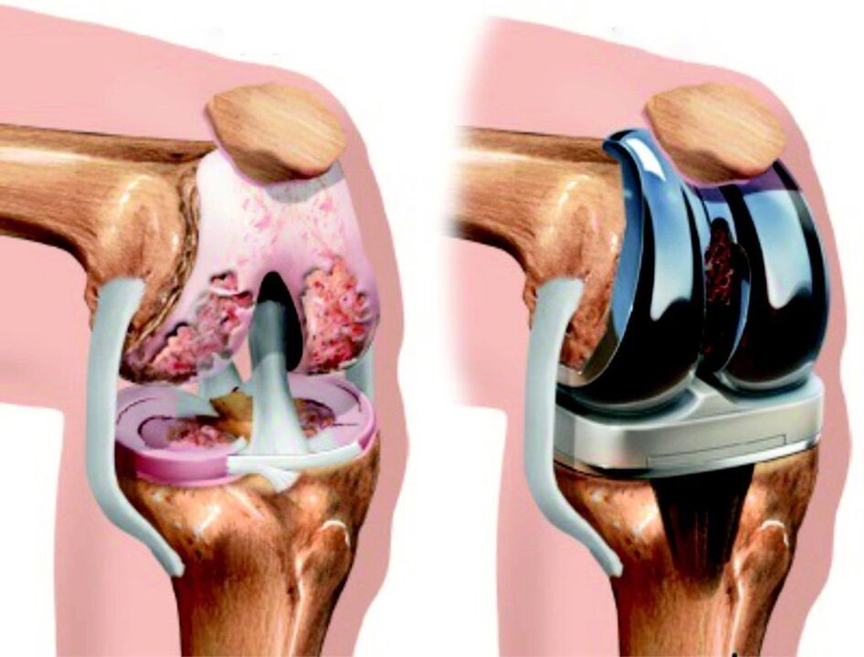 Bei einer vollständigen Schädigung des Kniegelenks durch Arthrose kann diese durch Endoprothesen wiederhergestellt werden. 