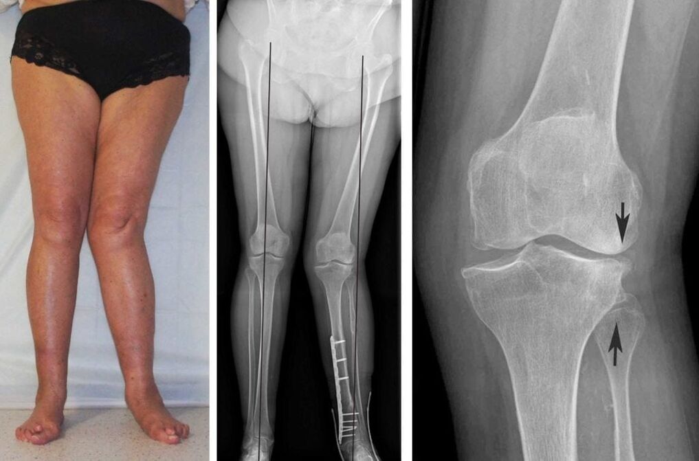 Eine fortgeschrittene Arthrose der Kniegelenke ist auch ohne Röntgen deutlich sichtbar. 