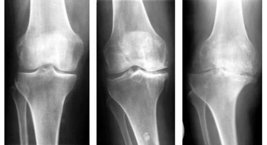 Eine obligatorische diagnostische Maßnahme bei der Feststellung einer Kniearthrose ist eine Röntgenaufnahme. 
